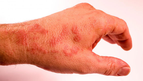 Alternative-Treatments-for-Ganglion-Cyst-Removal.-Irritation-from-the-Patch, ganglioncysttreatment.com