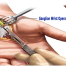 "G-Relief"-Blog-ganglion-wrist-cyst-operation"G-Relief"-Blog-ganglion-wrist-cyst-operation