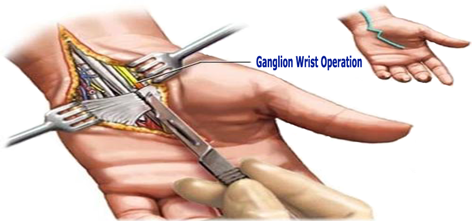 "G-Relief"-Blog-ganglion-wrist-cyst-operation"G-Relief"-Blog-ganglion-wrist-cyst-operation