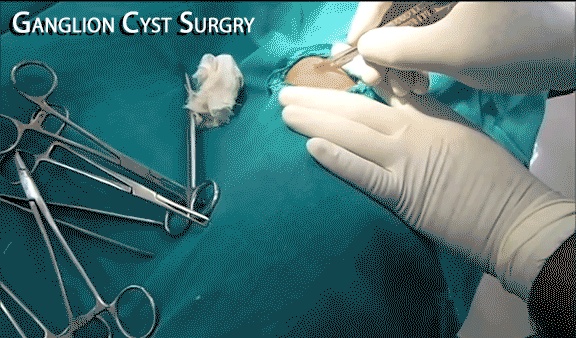 Ganglion Cyst Surgery G-Relief NATURAL Alternative. INFO g-relief.com