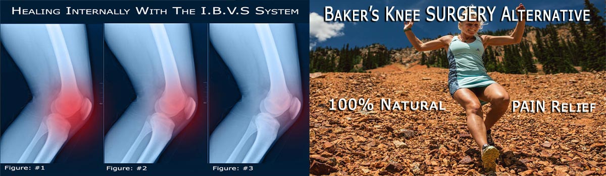 Baker's Knee Cyst SURGERY Alternative B-Relief SUPER Caps INFO:bakerstreatment.com