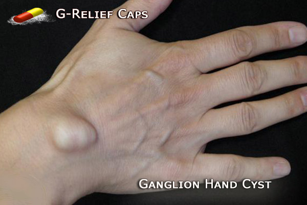 How to Remove Ganglion Hand Cysts. G-Relief Caps. 