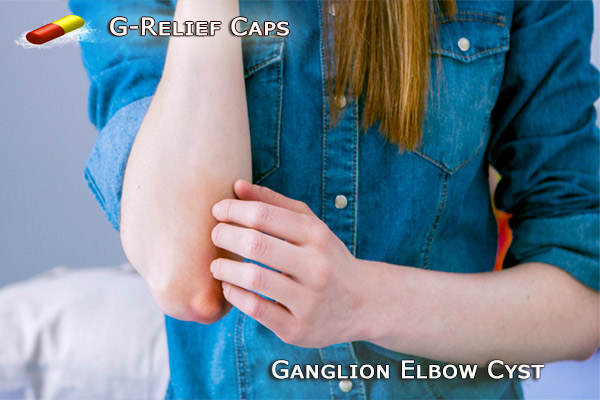 Cyst On Elbow Alternative to SURGERY. G-Relief Caps INFO g-relief.com