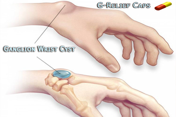 Ganglion-Wrist-Cyst-G-Relief-Caps All Natural Remedy