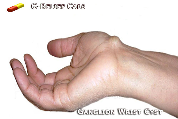 G-Relief Caps Natural Remedy for Ganglion Wrist Cysts