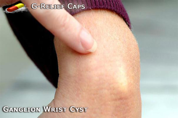 G-Relief Caps Natural Remedy for Ganglion Wrist Cysts INFO 