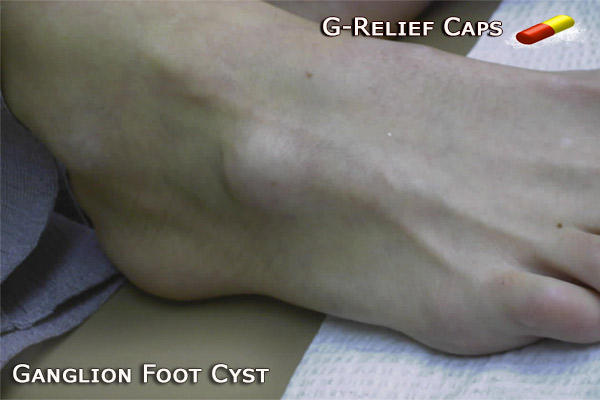 Ganglion Foot Cure G-Relief Caps
