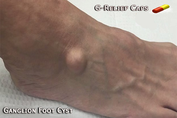G-Relief Caps Relief Caps Removes Ganglion Cyst Naturally