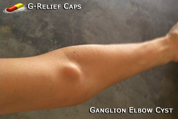 Ganglion-Elbow-Cyst-G-Relief-Caps Natural Cure for Cysts