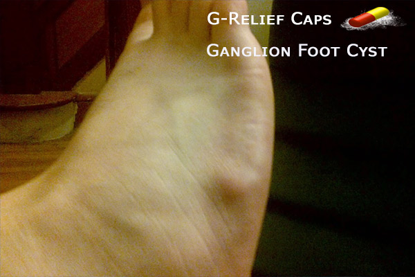 Ganglion-Foot-Cyst-Treatment with G-Relief-Caps-