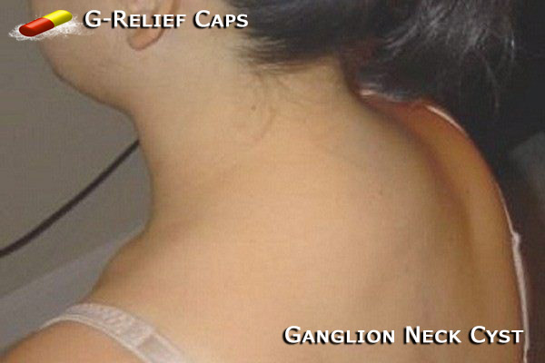 Ganglion-Neck-Cyst-G-Relief-Caps All Natural Treatment