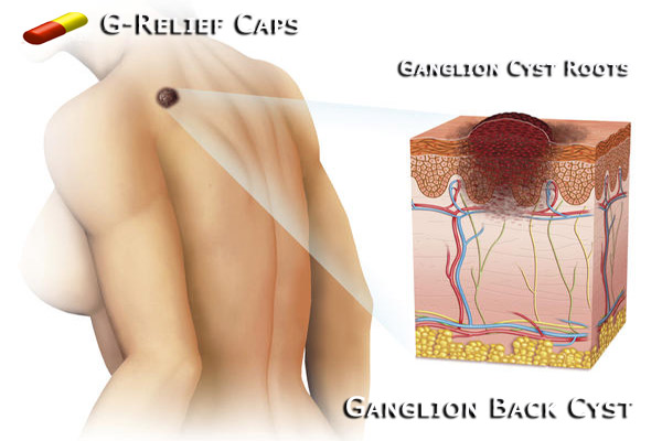 Ganglion-Back-Cyst-G-Relief-Caps All Natural Remedy. INFO: g-relief.com