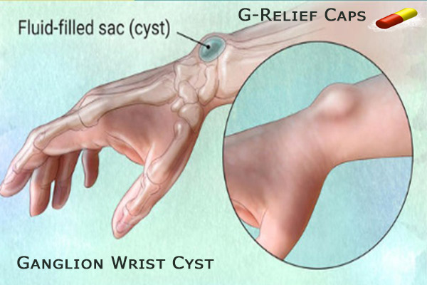 Heal Ganglion-Wrist-Cyst with G-Relief-Caps
