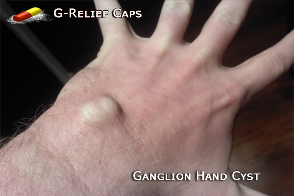 How to Naturally Remove Ganglion Hands