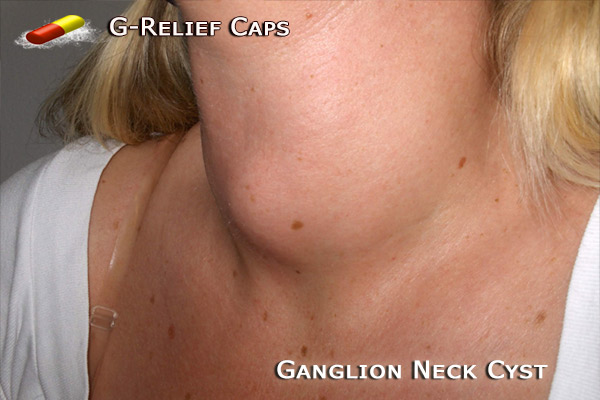 Ganglion neck Cyst Relief G-Relief Caps