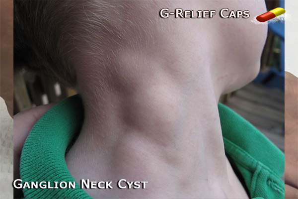 Ganglion Shoulder Cyst G-Relief Caps Ganglion Surgery Alternative.100% Natural 0% Recurrence. INFO: g-relief.caps