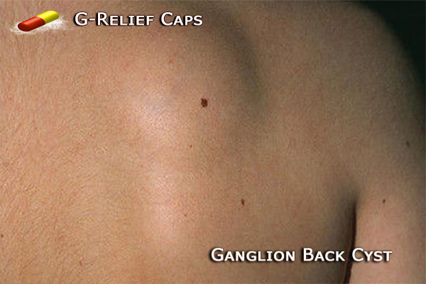 G-Relief Testimonial  Ganglion-Cyst-SURGERY-Alternative 100% Natural 0% Recurrence.