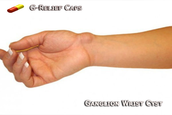 Ganglion Cyst Wrist SURGERY Alternative G-Relief Caps. Heals Wrist Cysts. Stops The Pain: INFO g-relief.com