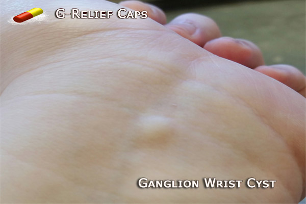 Ganglion-Wrist-Cyst-G-Relief-Caps Natural Remedy for Cysts 