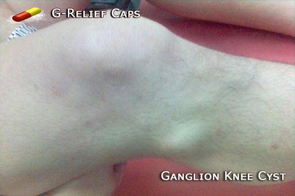 Knee Cyst SURGERY Alternative G-Relief Caps. INFO g-relief.com