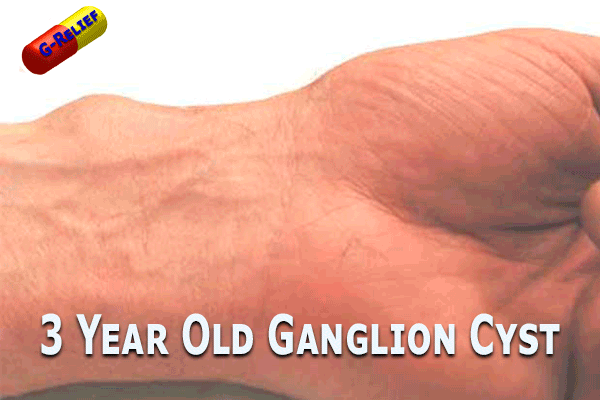 Ganglion-Cyst-SURGERY-Alternative-FDA-G-Relief-Caps